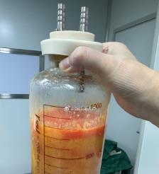 广安水动力吸脂手术要做多久？